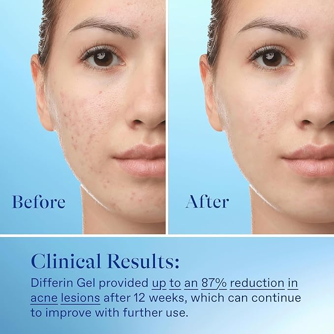 Differin Acne Treatment Gel, 30 Day Supply, Retinoid Treatment for Face with 0.1% Adapalene, Gentle Skin Care for Acne Prone Sensitive Skin, 15g Tube (Packaging May Vary)-Velvo Beauty