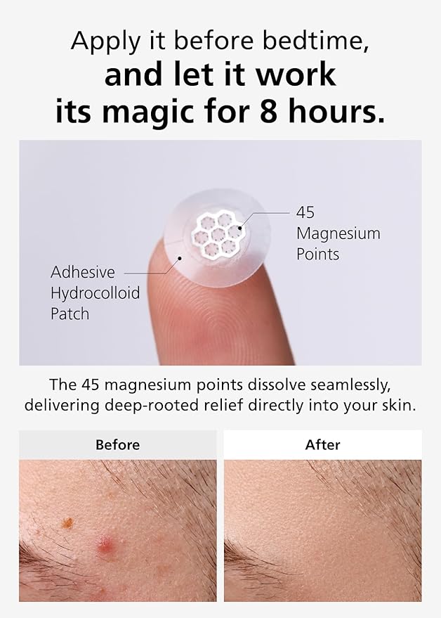 EasyDerm Quick Calming Magnesium Patches – Hydrocolloid Acne Spot Treatment Includes Tweezers & Ampoule, 10 Patches, Zit Sticker, Back to School MUST HAVE, Made by Daewoong Pharmaceutical-Velvo Beauty