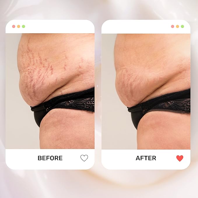 S1 Stretch Mark Cream, 150ml / 5oz, Lightweight Pregnancy Stretch Mark Cream-Velvo Beauty