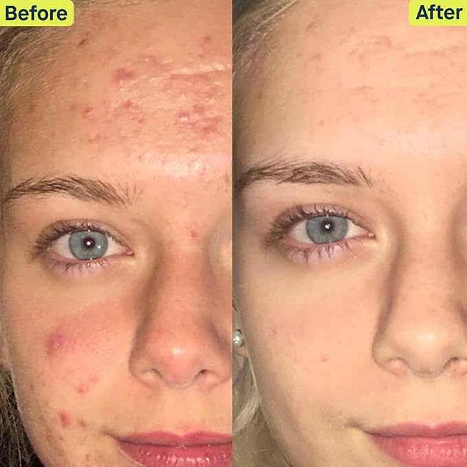 SLMD Skincare by Dr. Pimple Popper - 30-Day Acne System - 4-pc Kit - 3 Steps, 2x per Day Full Routine to Treat and Prevent All Stages of Acne-Velvo Beauty