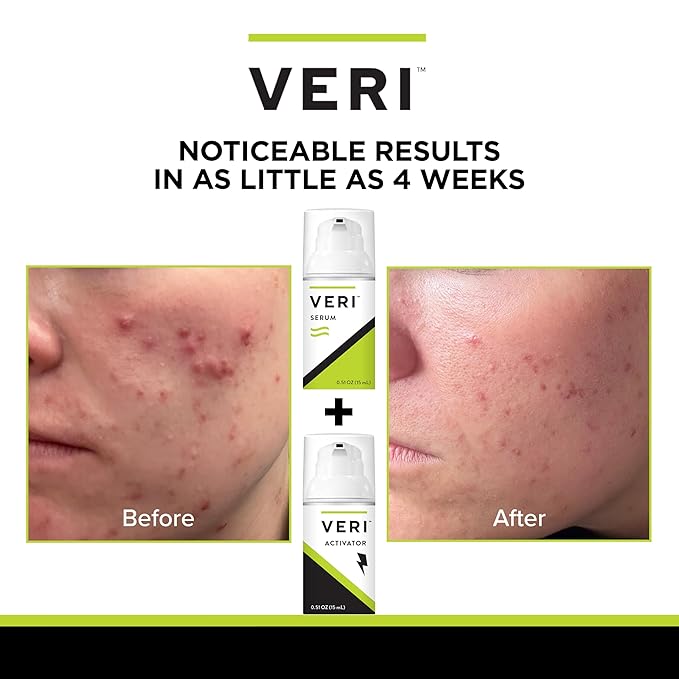 VERI Nitric Oxide + Salicylic Acid Clear Skin System (Peroxide-Free): For Acne Prone Skin, Unclogs Pores, Clarifies Blemishes, Reduces Inflammation, Prevent Future Breakouts, 30 mL / 1 oz-Velvo Beauty