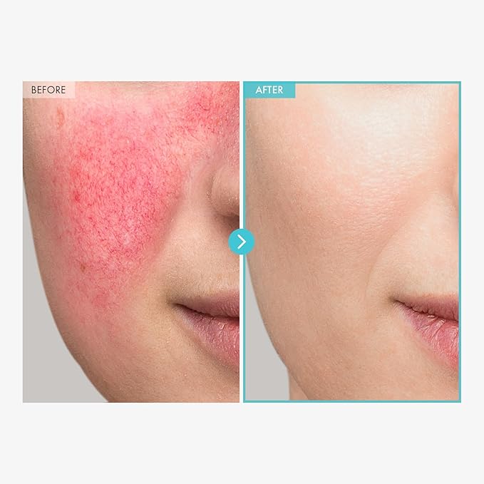 SOS Repair CICA Clinic Zinc Cream, 100,000ppm Zinc Oxide, Heal, Soothe Acne, Redness, Rosacea Treatment, Skin Barrier Repair, Moisture, Non-Comedogenic, Korean Skin care, 50g, 1.76 oz.-Velvo Beauty