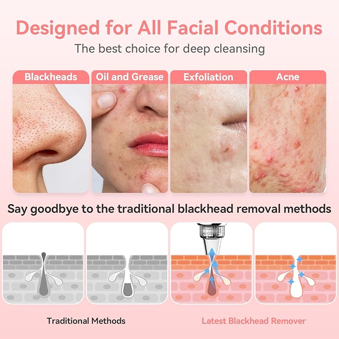 Blackhead Remover Pore Vacuum Upgraded Facial Pore Cleaner Electric Comedone Whitehead Extractor Tool-5 Suction Power,5 Probes,USB Rechargeable Blackhead Vacuum Kit for Women & Men-Velvo Beauty