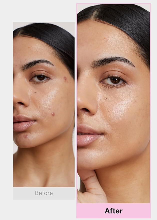 EasyDerm Multi-Step Pimple Patch Set – 4-Type Korean Pimple Patches + Free 2-in-1 Dual-Tip Extractor for Complete Skincare-Velvo Beauty