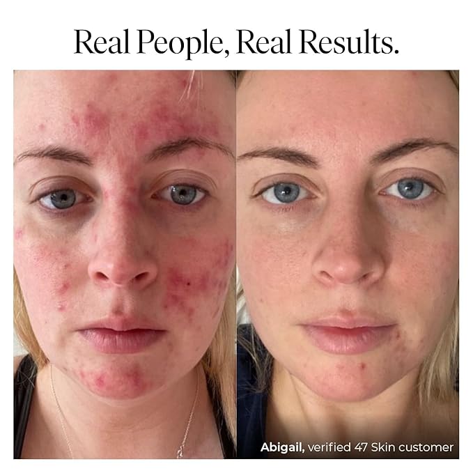 | Hydrating Face Serum with Silver Chitoderm for ALL Skin Types | Clears Acne, Prevents & Heals Breakouts & Blemishes, Repairs Scars | Moisturises and Nourishes For Smooth Skin | 30ml-Velvo Beauty