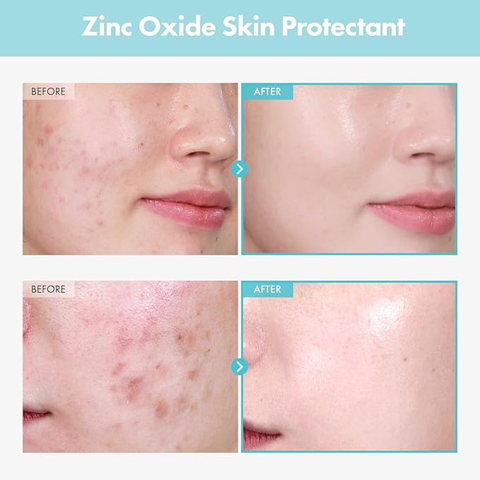 SOS Repair CICA Clinic Zinc Cream, 100,000ppm Zinc Oxide, Heal, Soothe Acne, Redness, Rosacea Treatment, Skin Barrier Repair, Moisture, Non-Comedogenic, Korean Skin care, 50g, 1.76 oz.-Velvo Beauty