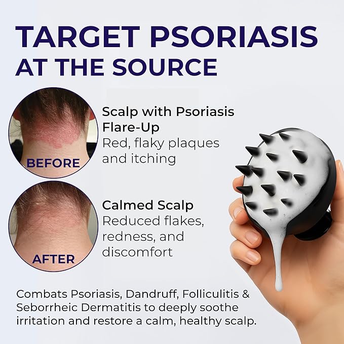 Scalp Psoriasis Shampoo, Flakes Shampoo Anti Dandruff, Itchy Scalp Treatment for Seborrheic Dermatitis & Folliculitis, Anti Fungal, Medicated Solution for Itchy, Flaky & Dry Hairs-Velvo Beauty