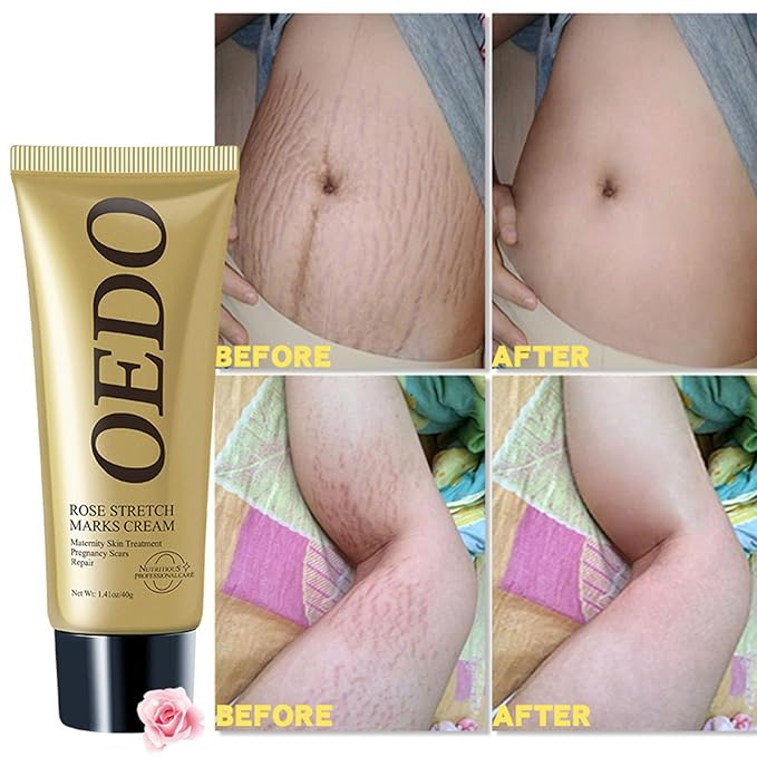 Rose Remove Stretch Marks Cream for Pregnancy Scar Removal Cream Natural Plant Essence Formula Prevention Remove Stretch Mark Old Scars Body Moisturizer 40g-Velvo Beauty