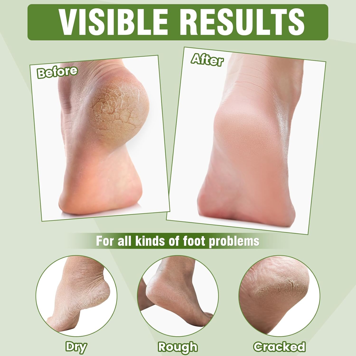 6 Pairs Moisturizing Foot Masks with Shea Butter, Jojoba Oil, Vitamin E & Urea, 6 Pairs Intensely Hydrating Foot Mask For Dry Cracked Feet, Moisturizing Socks for Cracked Heel Treatment-Velvo Beauty