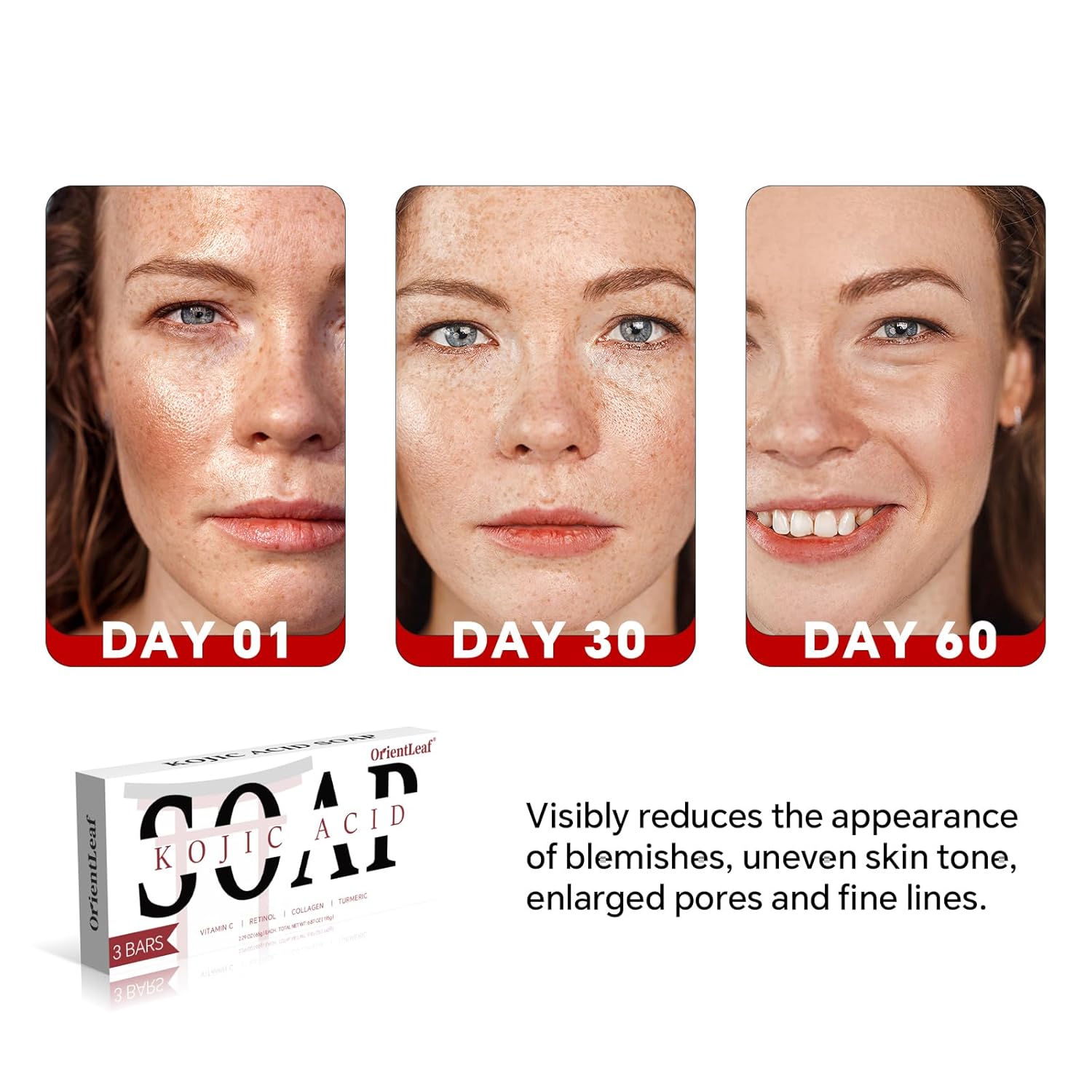 Kojic Acid Soap, Turmeric Soap Bar for Dark Spots, Fresh Citurs Scent, Gentle for Face and Body Wash with Vitamin C, Shea Butter, Retinol, Olive Oil, Collagen (3 PACK)-Velvo Beauty