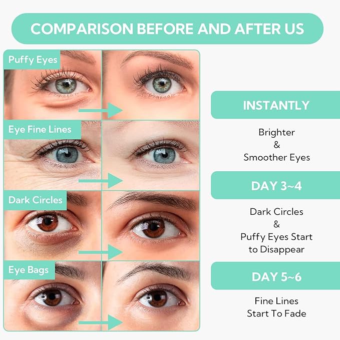 8X Hyaluronic Acid Under Eye Patches(30 Pairs) -Cooling Eye Masks for Deep Moisturizing, with Ectoin Niacinamide Hydra-Gel Collagen, Puffy Eyes Treatment, Fine Lines & Wrinkles Reduce-Velvo Beauty