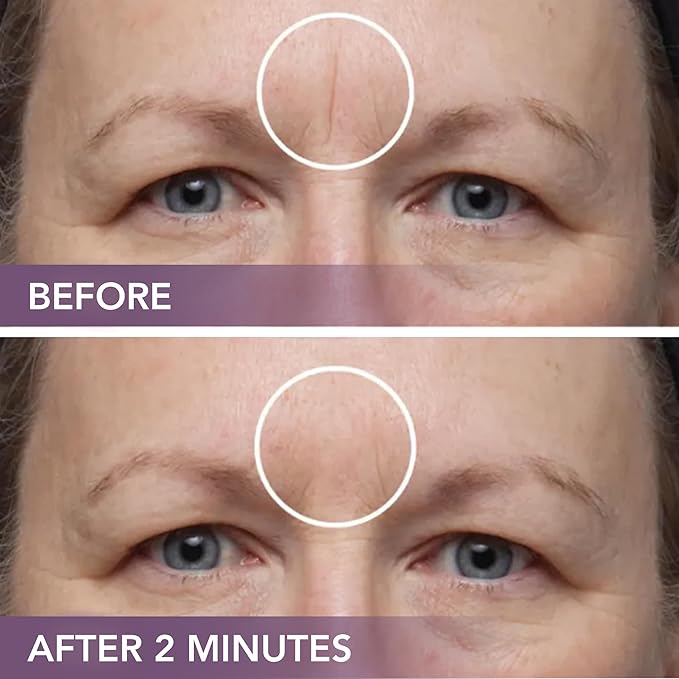 Dermaflage Scar Filler Kit - Medium - Deep Scar Cover and Waterproof Concealer for Acne Scars Wrinkles, and Ice Pick Scars Makeup, 1 mo supply-Velvo Beauty