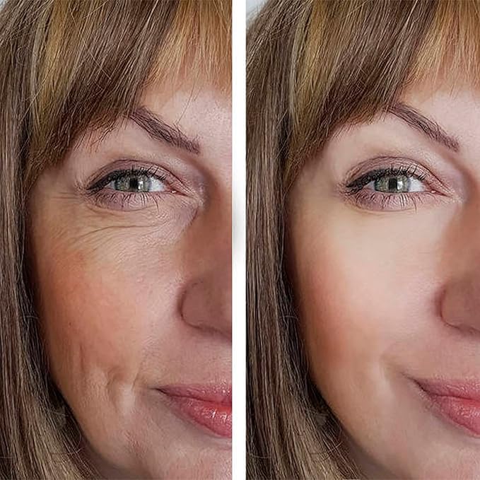 Pdo Lifting Thread, Pdo Threads Lift for Eyes, Helps Restore Skin's Firmness and Elasticity, and Improves Eye Wrinkles (20PCS-30G*25MM)-Velvo Beauty