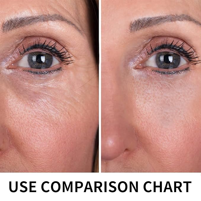 Pdo Threads Lift for Eyes, Pdo Lifting Thread, Improves Wrinkles And Sagging Around The Eye Area (20PCS-30G*25MM)-Velvo Beauty