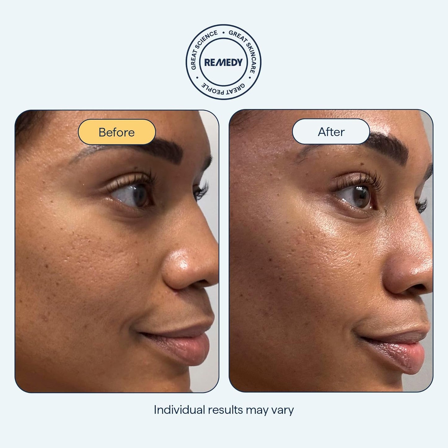 Remedy for Rich Moisture - Barrier Repairing Rich Cream Moisturizer for Normal to Dry Skin - Quadruple Ceramide Complex, Peptides, Squalane, Glycerin- By Dermatologist Dr. Shah, 1.7 fl. oz-Velvo Beauty