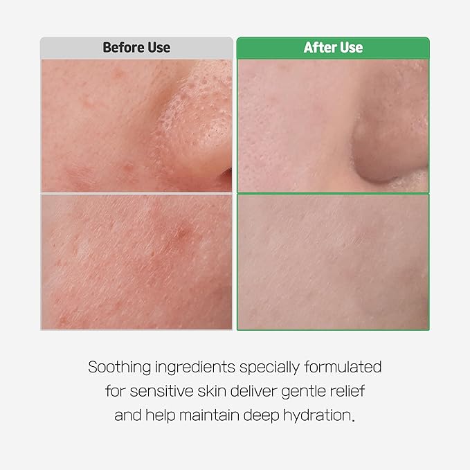 Cica Bio Spot Control Patch (1 Box, 62pcs) | Soothing Acne Patch for Redness & Blemishes | With Cica, Niacinamide & Tea Tree | Gentle for Sensitive Skin | Korean Skincare-Velvo Beauty