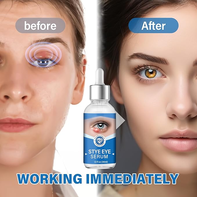 Stye Eye Treatment, Stye Eye Serum for Styes Chalazion and Blepharitis, Gently Cleanses Lashes and Eyes, Restore Healthier Eye Skin, 1 Fl.oz-Velvo Beauty