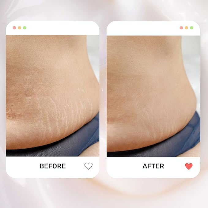 S1 Stretch Mark Cream, 150ml / 5oz, Lightweight Pregnancy Stretch Mark Cream-Velvo Beauty