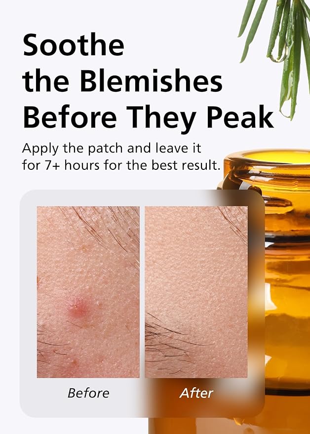 EasyDerm Relief Invisible Patch(42 counts) I Contains 10,000ppm of Tea Tree Oil, Pimple Patch, Ultra-slim 0.1mm, Waterpoof, Korean Pimple Patches Back to School MUST HAVE-Velvo Beauty