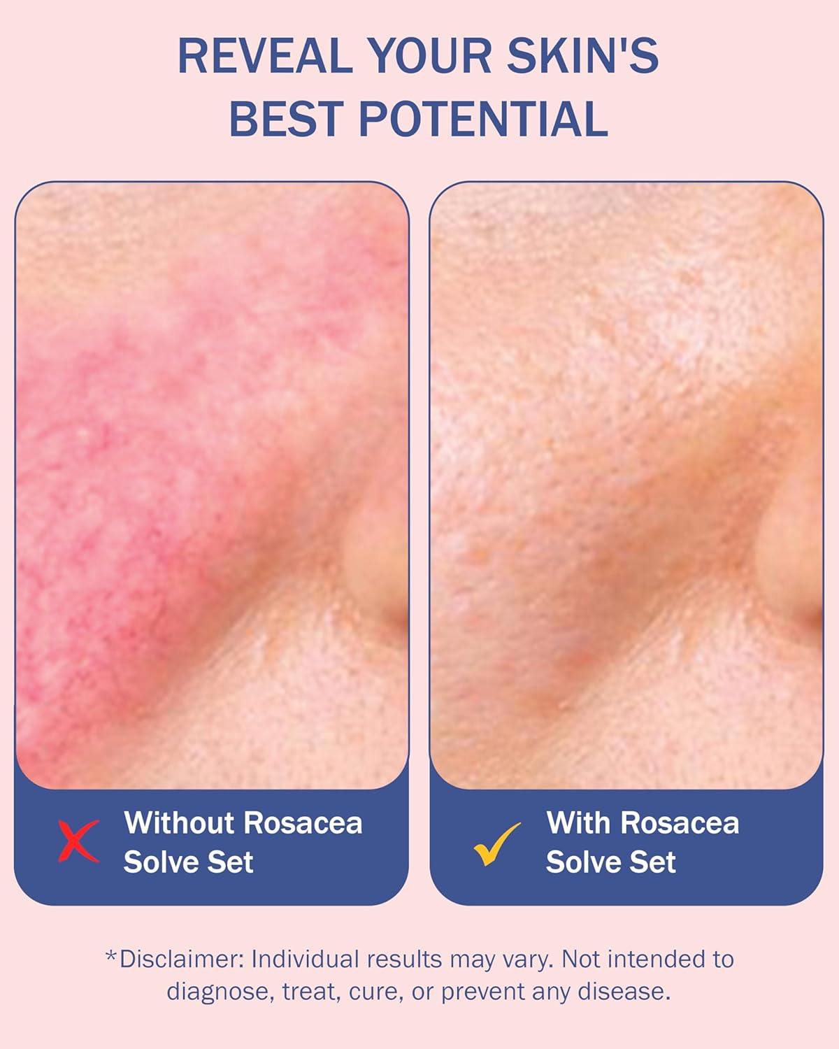 Rosacea Treatment Skincare for Women & Men - Face Wash, Rosacea Cream & Face Serum, Moisturizer Redness Reducing Skin Care with Aloe Vera, Hyaluronic Acid & Fruit Extracts, Made in USA by e70-Velvo Beauty