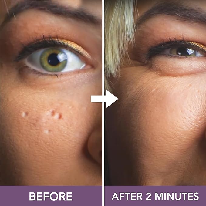 Dermaflage Scar Filler Kit - Light Tan - Deep Scar Cover and Waterproof Concealer for Acne Scars Wrinkles, and Ice Pick Scars Makeup, 1 mo supply-Velvo Beauty