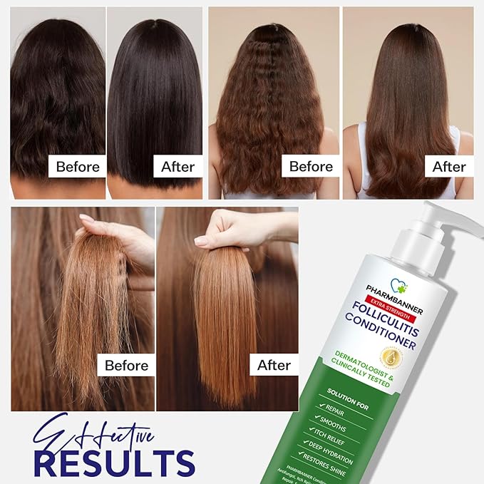 Folliculitis Itch Relief Conditioner: Tea Tree Oil & Moroccan Argan Oil - Deep Hydration & Repair - Nourishes, Smooths, Restores Shine - Safe for Dry or Damaged Hair-11.84 oz-Velvo Beauty