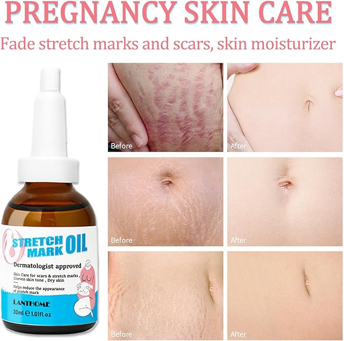 Stretch Mark Pregnancy Massage Oil, Stretch Mark Oil, Skincare Oil for Improve Stretchmarks, Pregnancy Skin Care Fade Stretch Marks, Body Moisturizer for Dry Skin, First Time Mom Gift 30 ml-Velvo Beauty