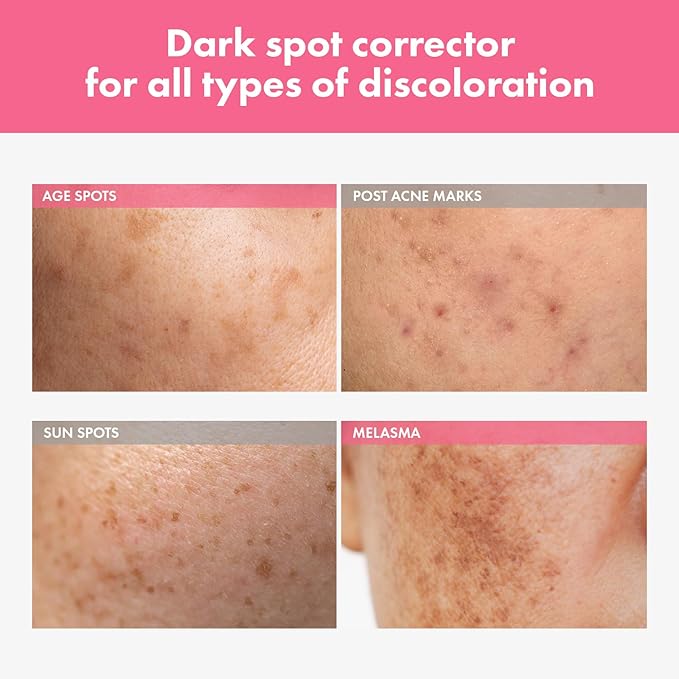 Arbutin 7% Intensive Spot Cream with 70,000ppm Arbutin, 3% Tranexamic Acid, 1% Niacinamide, Glutathione, Dark Spots, freckle, Blemishes, Anti-pigmentation, Korean Skin Care, 20ml, 0.67 fl.oz-Velvo Beauty