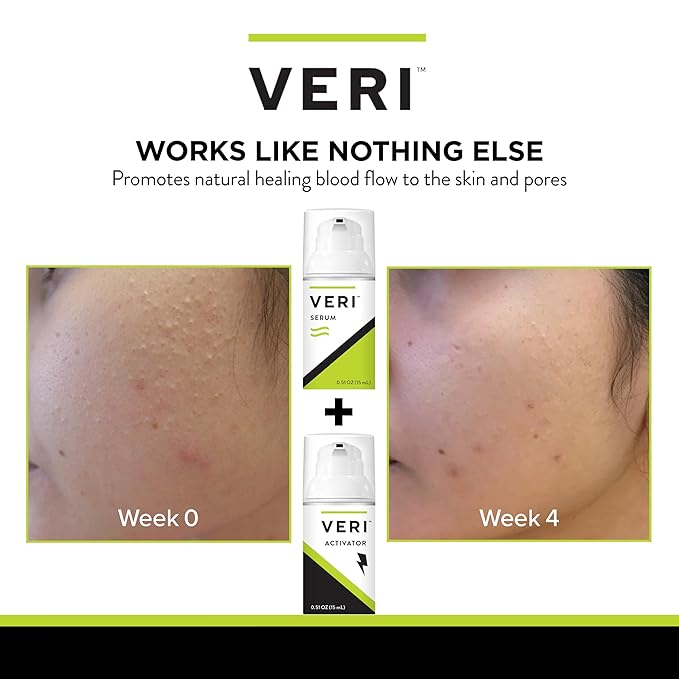 VERI Nitric Oxide + Salicylic Acid Clear Skin System (Peroxide-Free): For Acne Prone Skin, Unclogs Pores, Clarifies Blemishes, Reduces Inflammation, Prevent Future Breakouts, 30 mL / 1 oz-Velvo Beauty