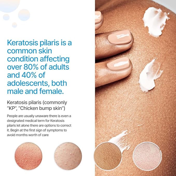 KP Essentials - Keratosis Pilaris Body Scrub and Exfoliator Cream Set - 10oz Exfoliating Set-Velvo Beauty