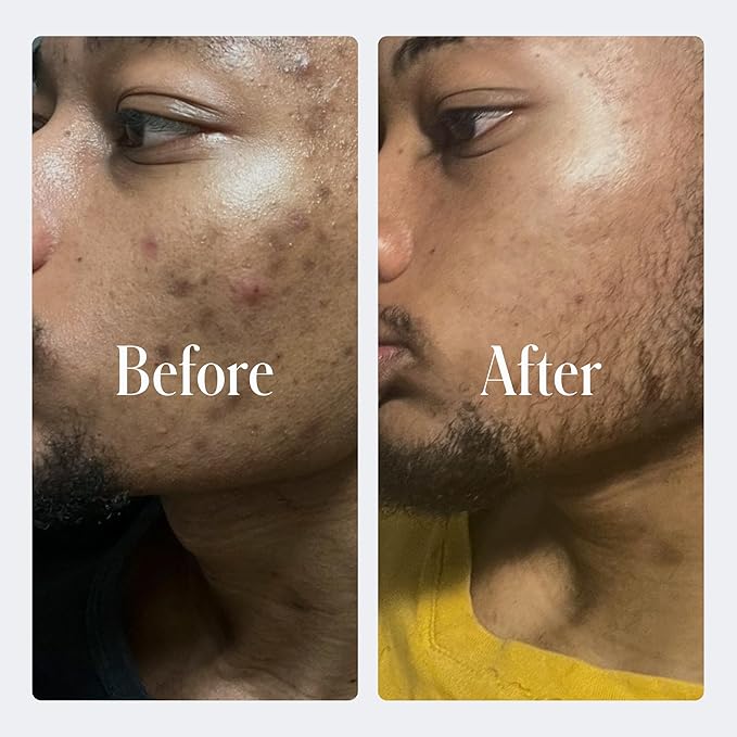 Geologie Clear System | 3-Step Acne Treatment & Skincare Set | Clears Skin Fast | Acne Gel Cleanser, SPF15 Day Cream & .3% Retinol Face Cream For Men & Women | Month 3+ / Level 3-Velvo Beauty