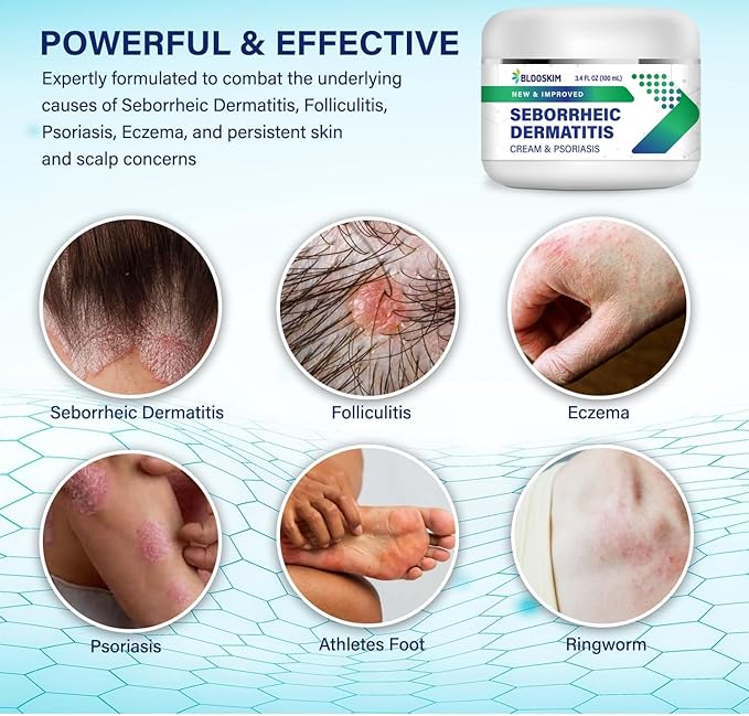 Seborrheic Dermatitis Face Cream – Face, Scalp & Body Moisturizing Treatment for Flaky, Itchy Skin – Daily Lotion for Psoriasis and Dermatitis Relief - Men and Women - 3.4 Fl Oz-Velvo Beauty