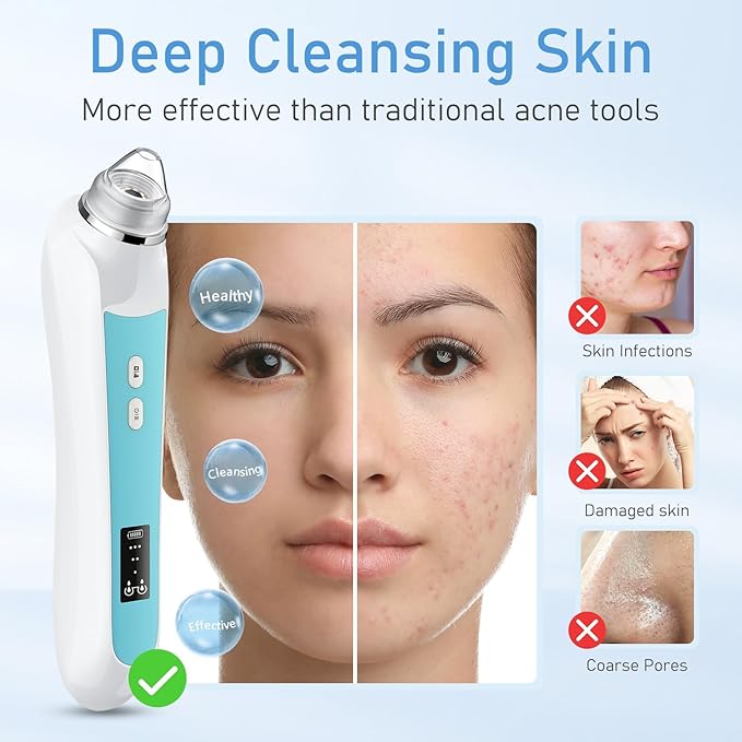 Facial Pore Blackhead Remover Vacuum, 1080P Camera Blackhead Remover, 20x Zoom, 8 LEDs ＆ 3 Suction Modes, 800mAh Battery & USB - 6 Heads Pore Cleaner Kit for Women&Men(Blue)-Velvo Beauty