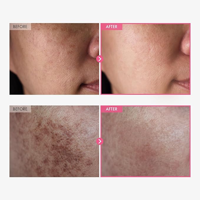 Arbutin 7% + Tranexamic Acid 4% Cream, 70,000ppm Arbutin, 40,000ppm TXA, Niacinamide, Glutathione, Dark Spots, Freckle, Blemishes, Pigmentation, Korean Skin Care, 50ml, 1.69 fl.oz.-Velvo Beauty