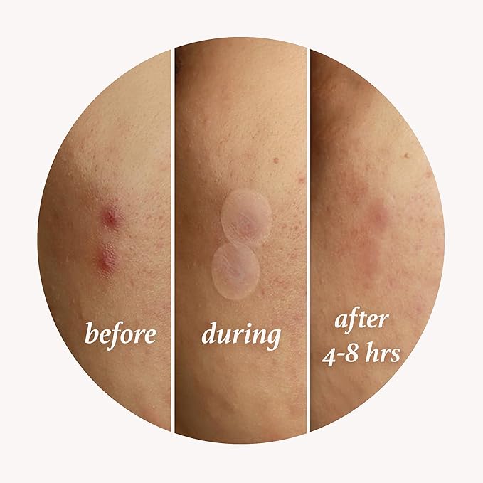 Julep Patch Me Up Waterproof Pimple Patches for Face – 72 Hydrocolloid Clear Acne Patches with Tea Tree Oil, Ultra-Thin Acne Stickers, Reduces Blemishes & Scarring – 48 8mm & 24 12mm Patches-Velvo Beauty
