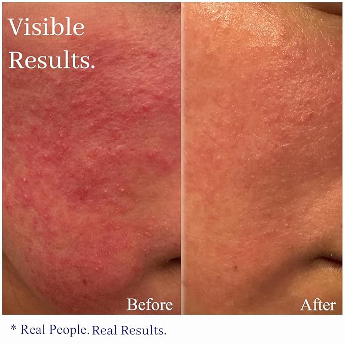 Hey Honey Skincare Relax, Instant Rosacea Treatment & Face Redness Relief - Dermatologically Tested Calming Moisturizer for Sensitive Skin Oil- Free with Honey & Propolis Anti-Aging Benefits | 2.2 Oz-Velvo Beauty