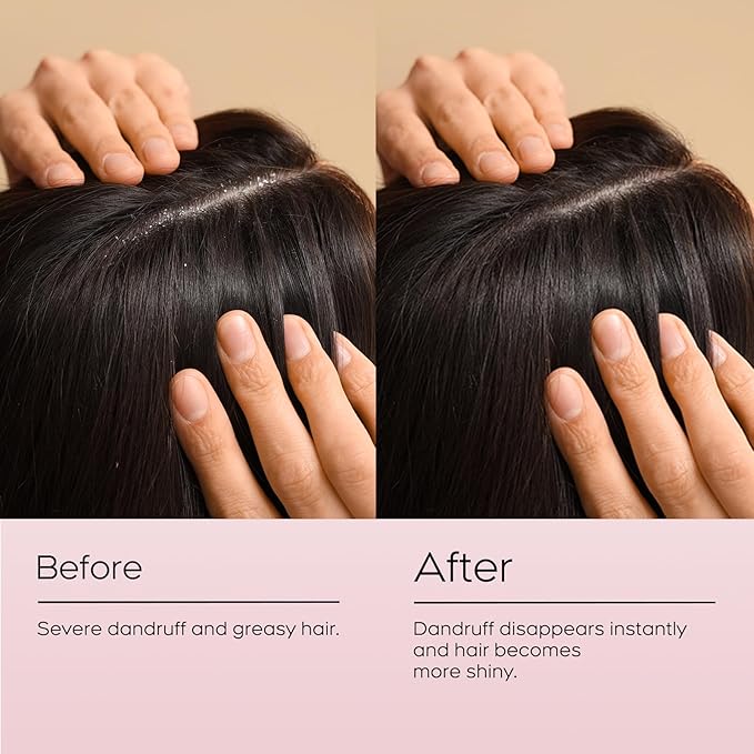 24HR Fast Itch Relief Anti-Fungal Shampoo for Psoriasis, Seborrheic Dermatitis & Folliculitis, Relieves Itchy, Dry Scalp, Sulfate & Paraben Free Anti-Dandruff Shampoo for Men and Women, 8.4 fl oz-Velvo Beauty