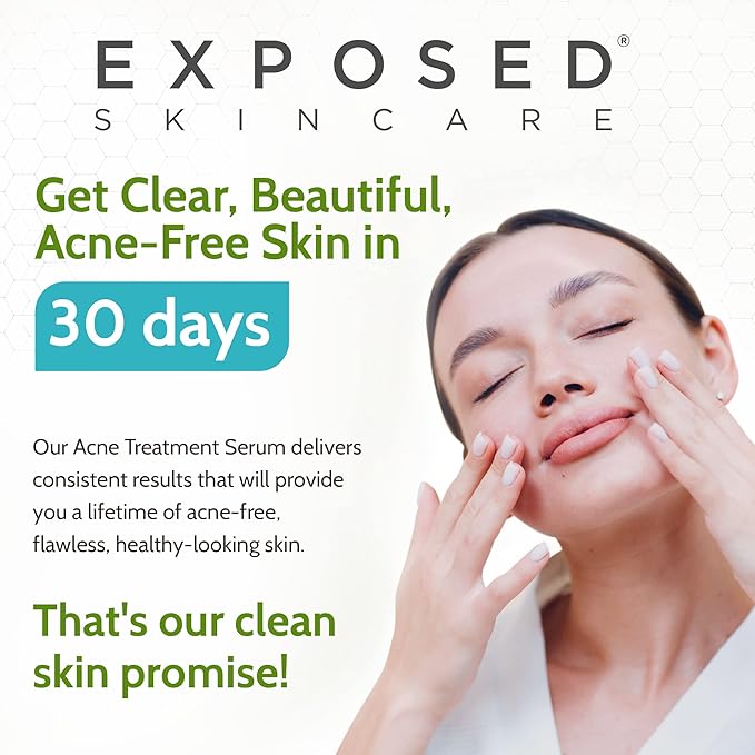 Exposed Skin Care Acne Treatment Serum Step 3 – Quickly Reduces Pimple Size and Redness - 12 Hour Spot Treatment - 3.5% Benzoyl Peroxide, Natural Green Tea & Tea Tree Oil-Velvo Beauty