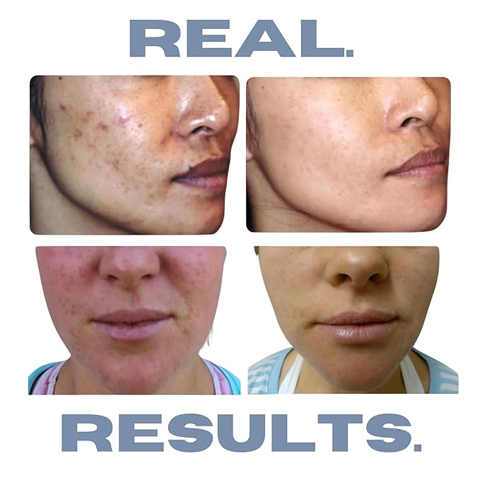 Acne Treatment Kit, Acne Kit, Skin Care Acne, Acne Skin Care Set, Natural Anti-DHT Deluxe Set Sensitive Skin 3-Piece Set, 2-Month Supply-Velvo Beauty