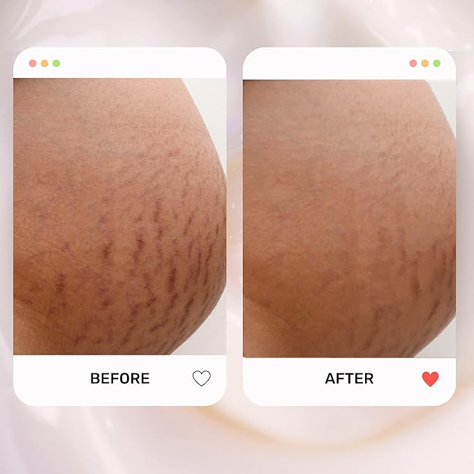 S1 Stretch Mark Cream, 150ml / 5oz, Lightweight Pregnancy Stretch Mark Cream-Velvo Beauty