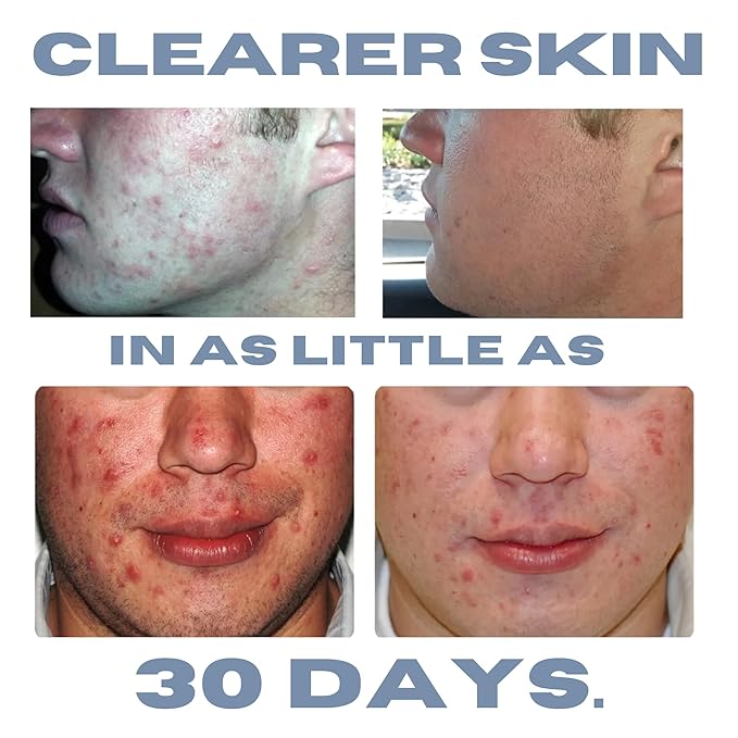 Acne Treatment Kit, Acne Kit, Skin Care Acne, Acne Skin Care Set, Natural Anti-DHT Deluxe Set Sensitive Skin 3-Piece Set, 2-Month Supply-Velvo Beauty