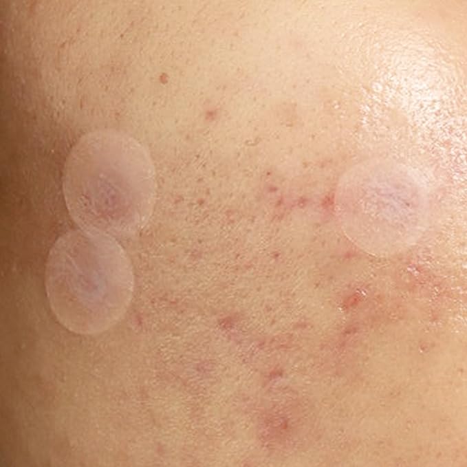 Julep Patch Me Up Waterproof Pimple Patches for Face – 72 Hydrocolloid Clear Acne Patches with Tea Tree Oil, Ultra-Thin Acne Stickers, Reduces Blemishes & Scarring – 48 8mm & 24 12mm Patches-Velvo Beauty