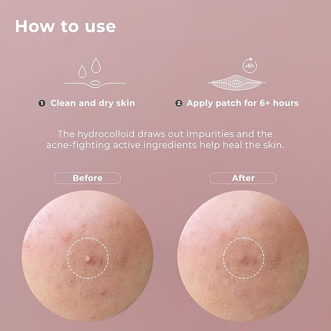 OMMA Korean Pimple Patches for Face with Hydrocolloid Patch, Invisible Blemish Pimple Stickers Acne Dots - Salicylic Acid Whiteheads Fast Acne Spot Treatment - 10 mm Zit Patches (72 Count)-Velvo Beauty