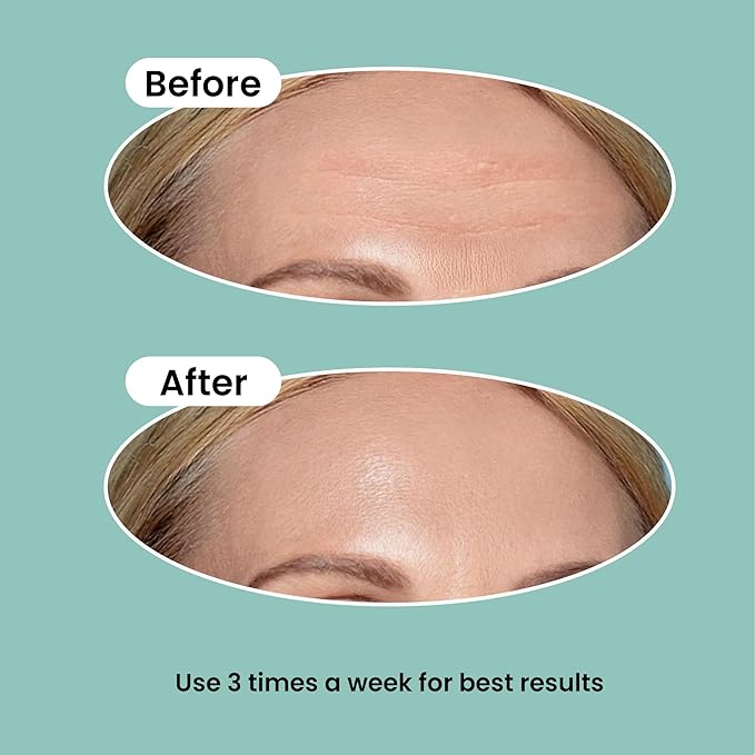 Advanced Wrinkle Patches 60ct Smile Line, Frown Line Wrinkle Patches for Facial Korean Skin Care Face Wrinkle Tape Invisible Overnight with Retinol & Collagen (Large (Forehead))-Velvo Beauty