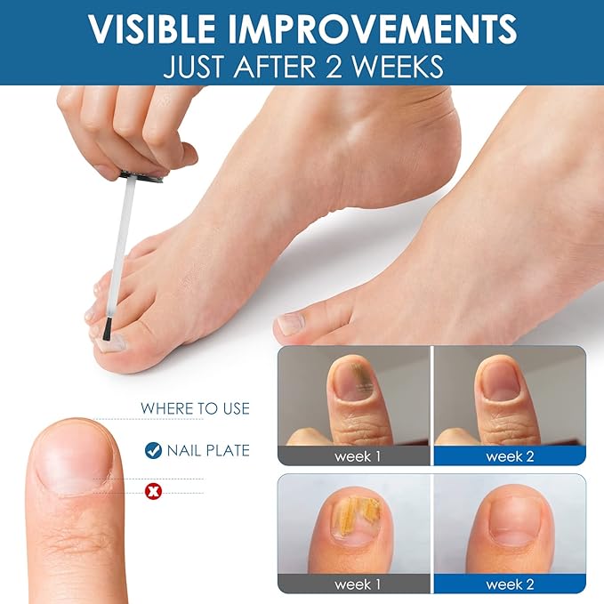 Toenail Repair Treatment, Extra Strength Nail Repair Liquid with Natural Tea Tree Oil Extract, Toenail Repair Solution for Thickened and Ingrow Nails-Velvo Beauty