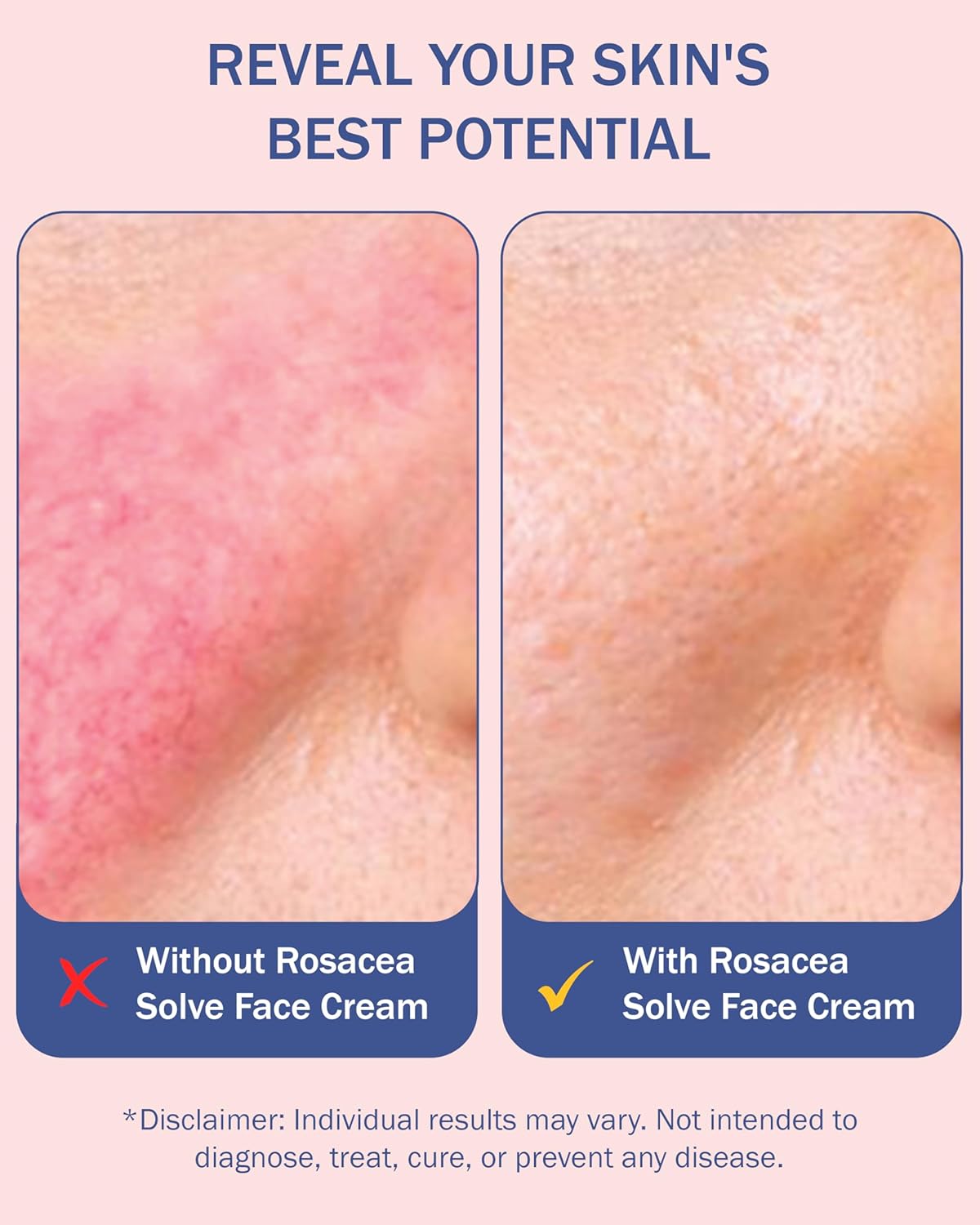 Rosacea Treatment for Face Skincare Cream for Women & Men (Pack of 2) - Gentle Moisturizer Redness Reducing Skin Care - with Aloe Vera & Hyaluronic Acid - Day-Night, Made in USA by e70 (2.25 fl. oz.)-Velvo Beauty