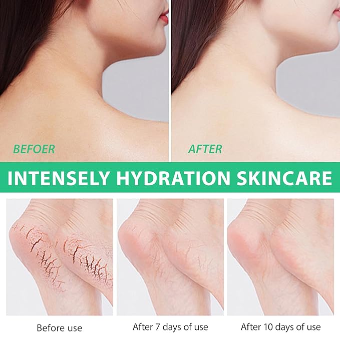 J&H Jasmine&Hyacinth 40% Urea Cream with 2% Salicylic Acid, Aloe, Feet/Heel Cream Moisturizer for Dry Cracked Heel, Knees, Elbows, Hands, Callus Remover, Intensive Hydrating Treatment-5.3 OZ/150 G-Velvo Beauty