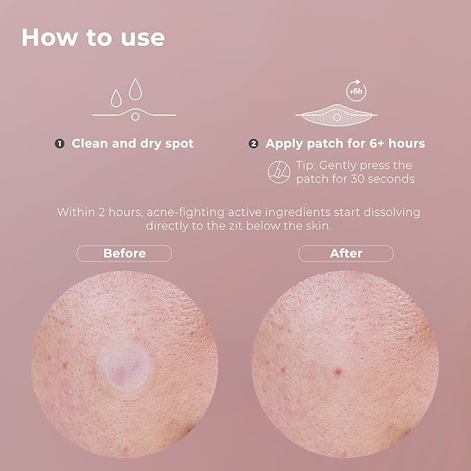 OMMA Korean Microdart Acne Patch, Cystic Acne Treatment, Micropoint Pimple Patches for Face for Early-Stage Painful Zits, Salicylic Acid & Tea Tree - 14 mm Zit Stickers (18 Count)-Velvo Beauty