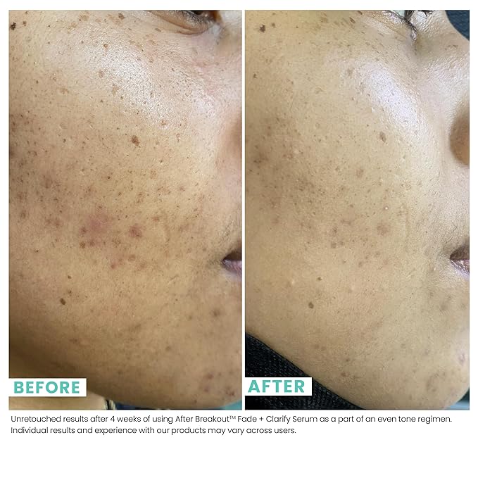 Urban Skin Rx, Acne & Dark Spot Essentials Starter Kit, Includes Clear Skin Cleansing Bar, Acne Serum + Spot Treatment & Fade + Clarify Serum, Cleanses Pores, Fades & Fights Breakouts-Velvo Beauty