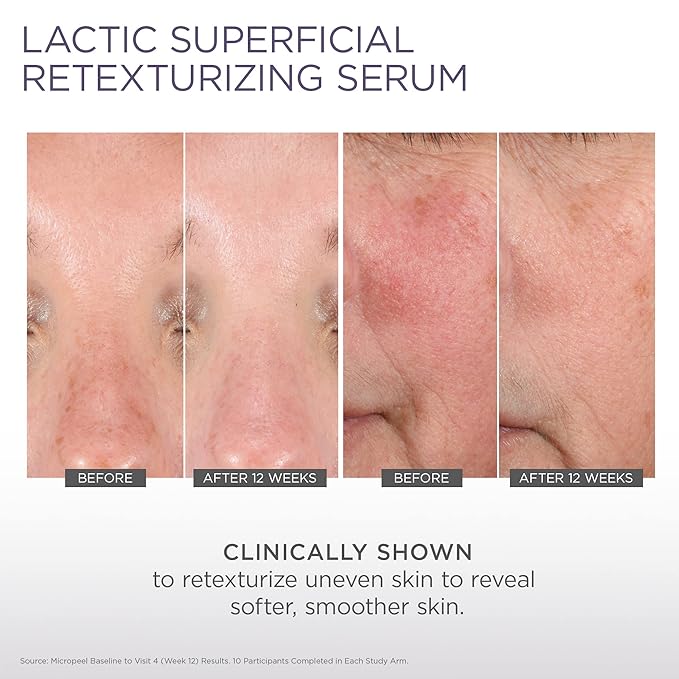 Glytone Micro-Peel Lactic Superficial Retexturizing Serum | Anti-Aging AHA Exfoliating Serum for Face with 10% Lactic Acid | Hydrates, Brightens & Reduces Wrinkles | Paraben-Free - 1 Fl oz-Velvo Beauty